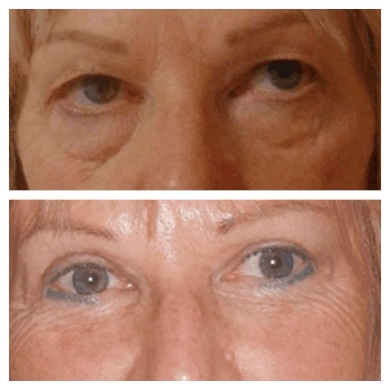 Eye Bag Removal Trends in 2025: Insights from the Best Eye bag removal Surgeons in dubai