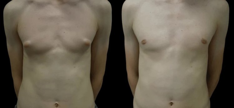 Gynecomastia Surgery in Dubai: How to Choose the Right Surgeon